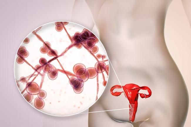 Mycose vaginale et vaginose